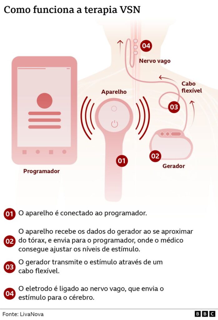 imagem como funciona terapia com implante para depressão; gráfico mostra como implante de tratamento para depressão resistente age; tratametno inovador para depressão chega ao Brasil