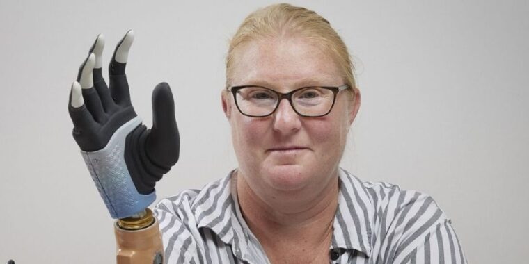 Karin com sua prótese imagem de Bionics Institute; paciente tem mão biônica revolucionária e recupera atividades diárias; mão biônica inovadora se conecta a ossos do paciente; mão robótica