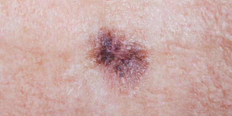nova terapia contra câncer de pele reduz rismo de morte pela metade; melanoma maligno foto; câncer de pele; tratamento para câncer de pele inovador